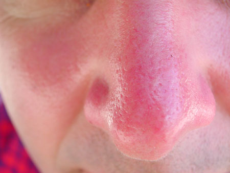 Suburnt nose