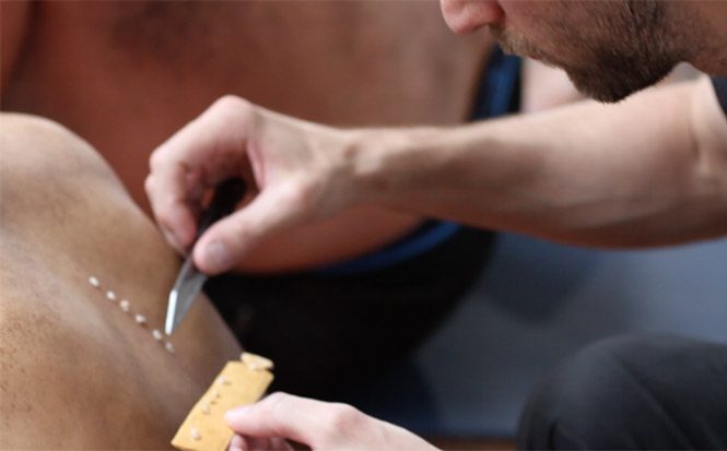 applying kambo