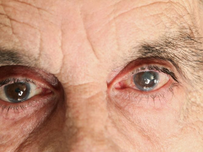glaucoma